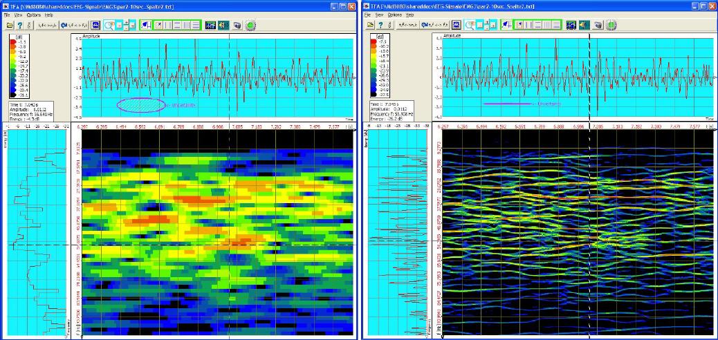EMG-Signal, elektrische Pulse der Muskelsteuerung: