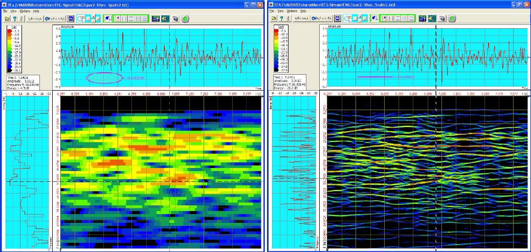 EMG-Signal, elektrische Pulse der Muskelsteuerung: